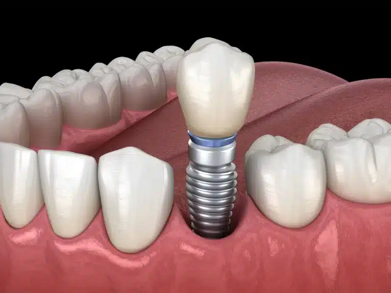 Tecnologia avanzata per impianti dentali permanenti.