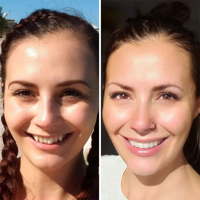 Risultato prima e dopo un trattamento ortodontico Invisalign presso OrthoDental