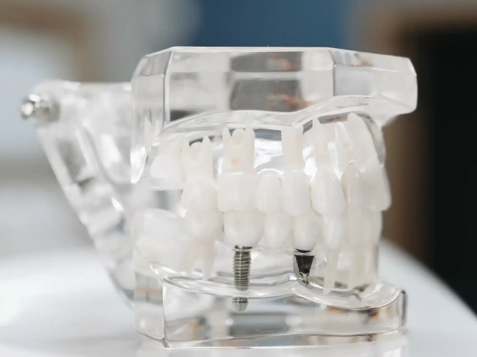 Un dentista tiene una mascella artificiale con un impianto dentale.